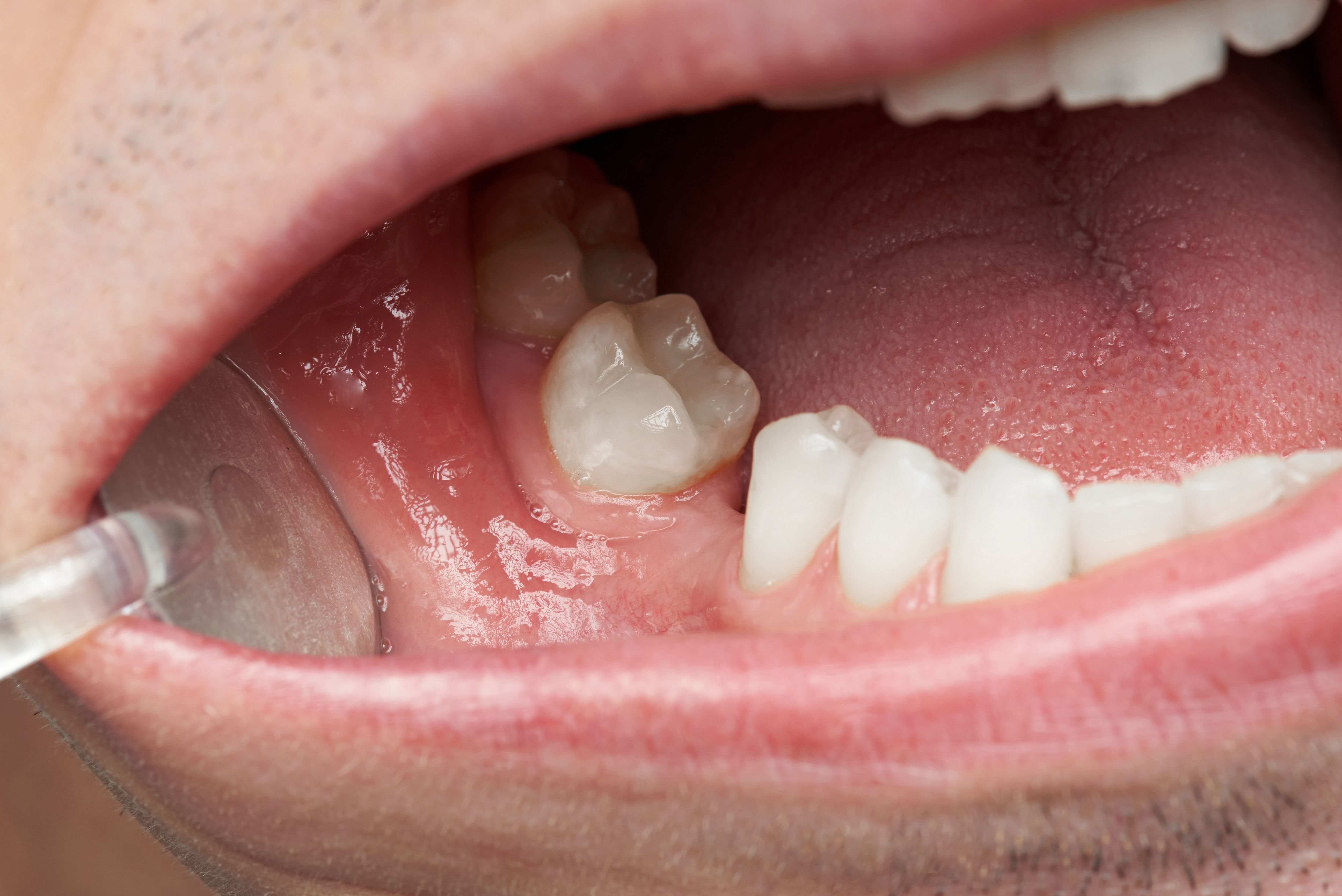 Human trials will focus on people who lack at least one molar. 